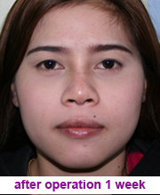 plastic_surgery_augmentation_rhinoplasty